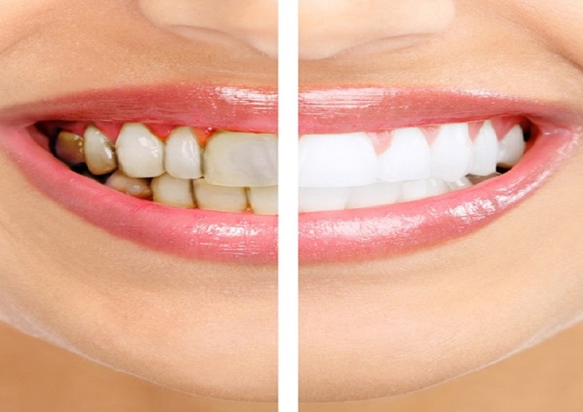 Estetik Diş Hekimliği